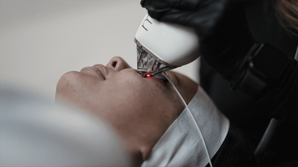 moxi laser being used on woman's face to get rid of skin pigmentation for health radiant skin
