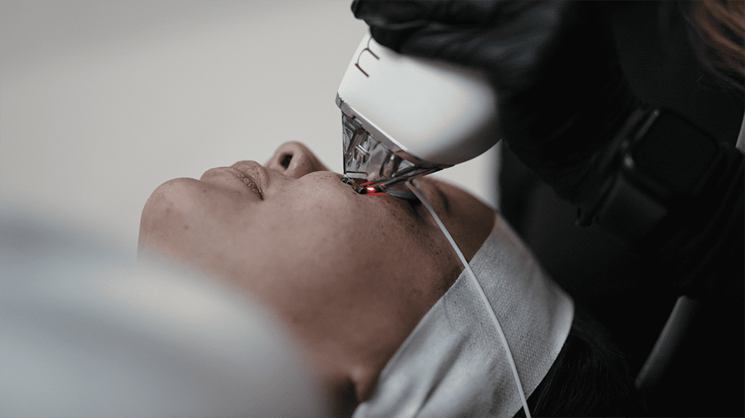Moxi Laser London Ontario - Kontour Medical Aesthetics