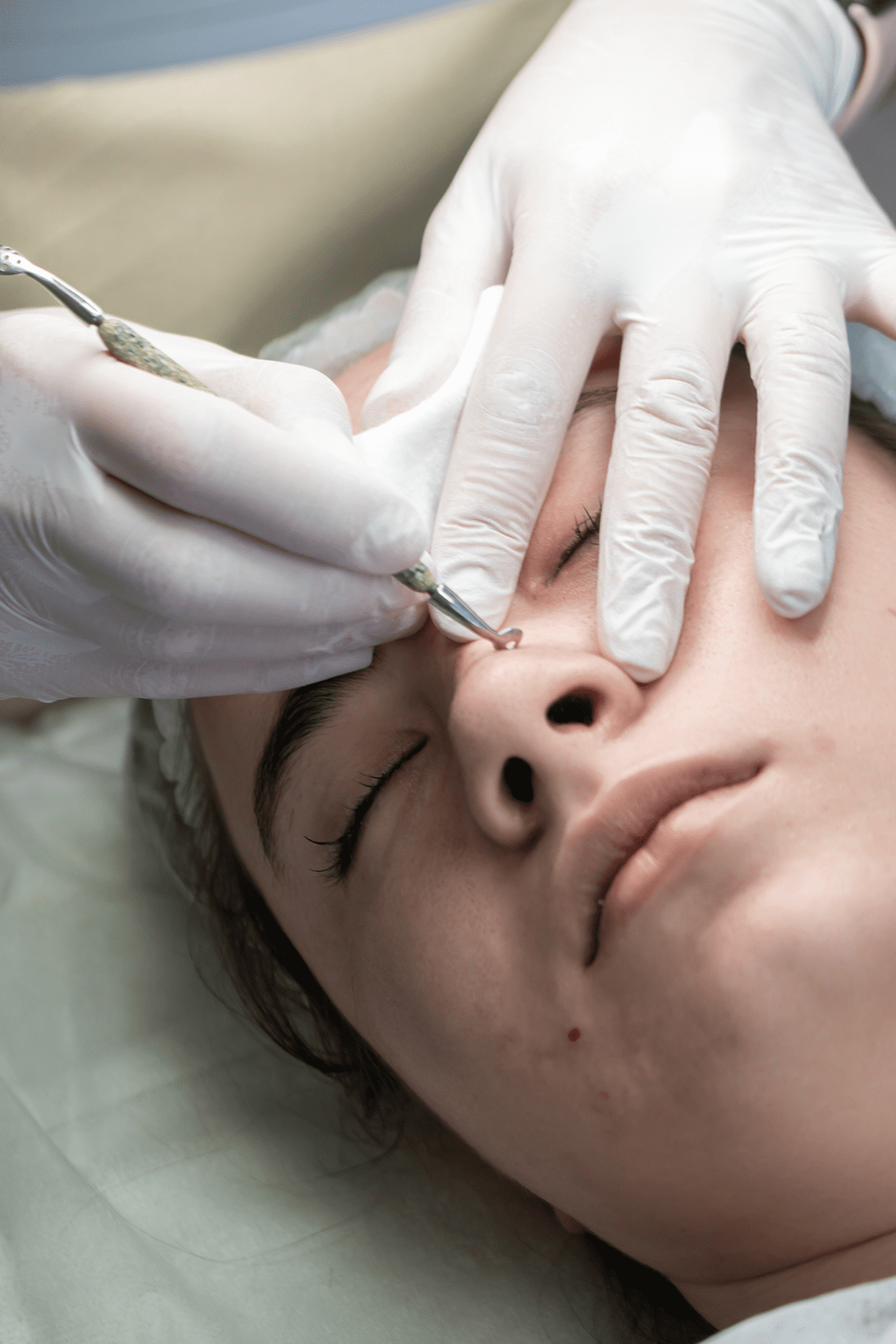 woman getting Blackhead extraction on her face skin