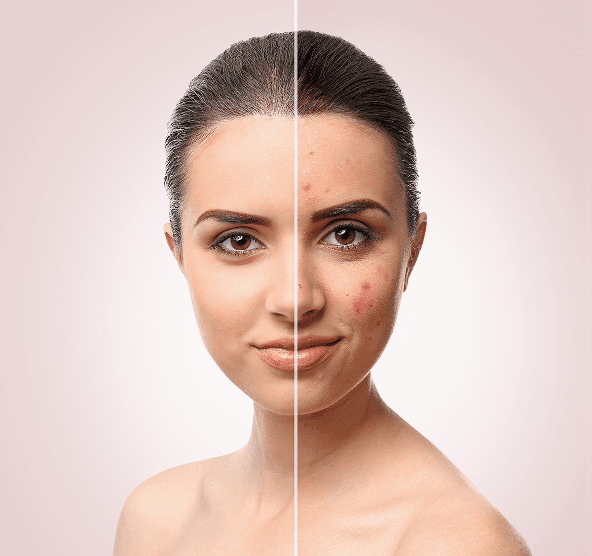 before and after picture of a woman with acne on her face after receiving acne treatment at Kontour