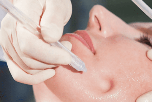 closeup of woman receiving a jetpeel facial in London Ontario