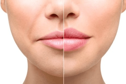 before and after picture of lip filler