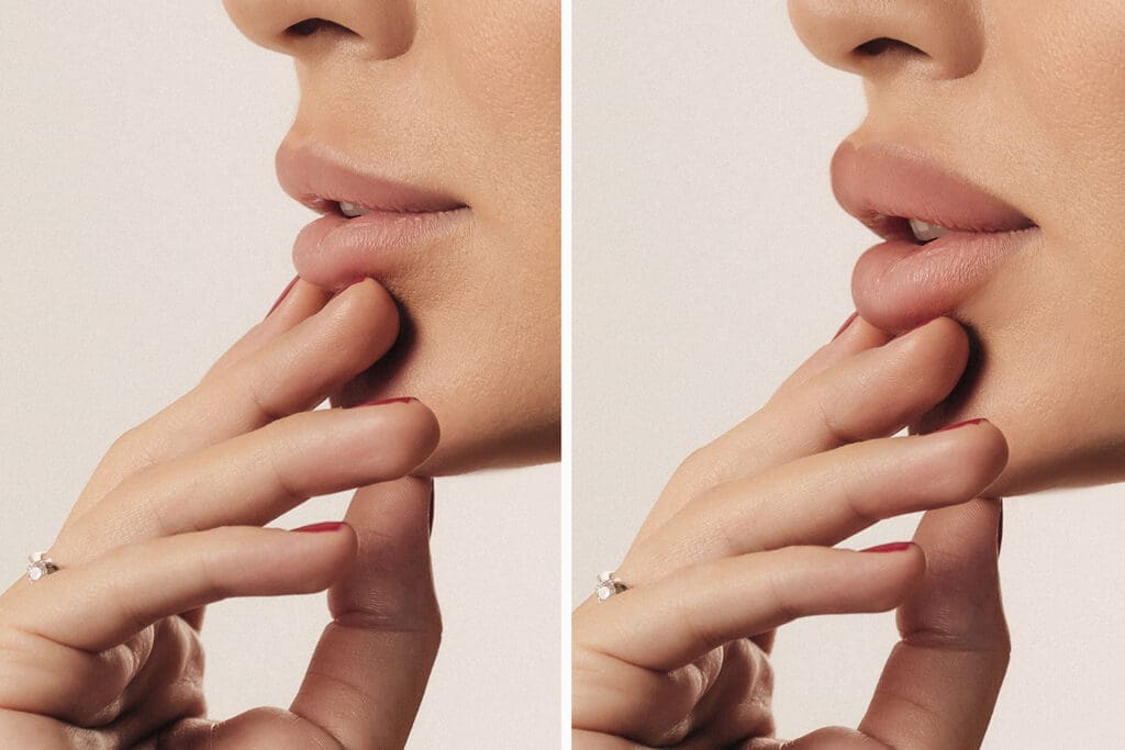Woman's face side view close-up before and after Botox lip filler injections London, Ontario. Lip augmentation.