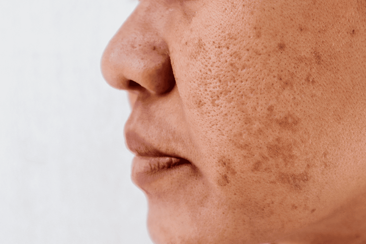 closeup of woman's face with skin pigmentation