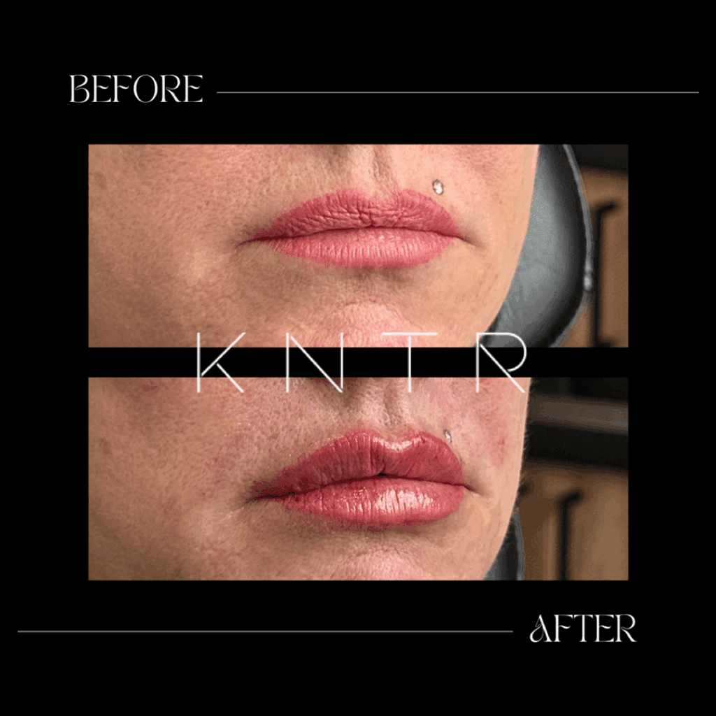 Before and after natural lip enhancement at Kontour by Belita Savage in London, Ontario showing balanced volume and definition.